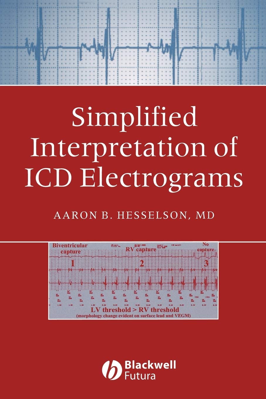Simplified Interpretation of ICD Electrograms by Hesselson,